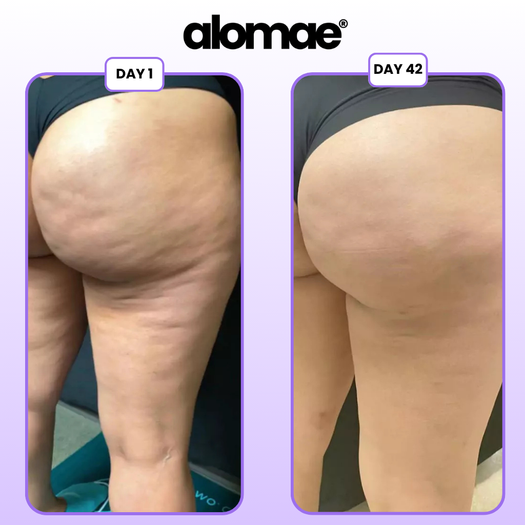 Alomae | Cellulite Relief Kit